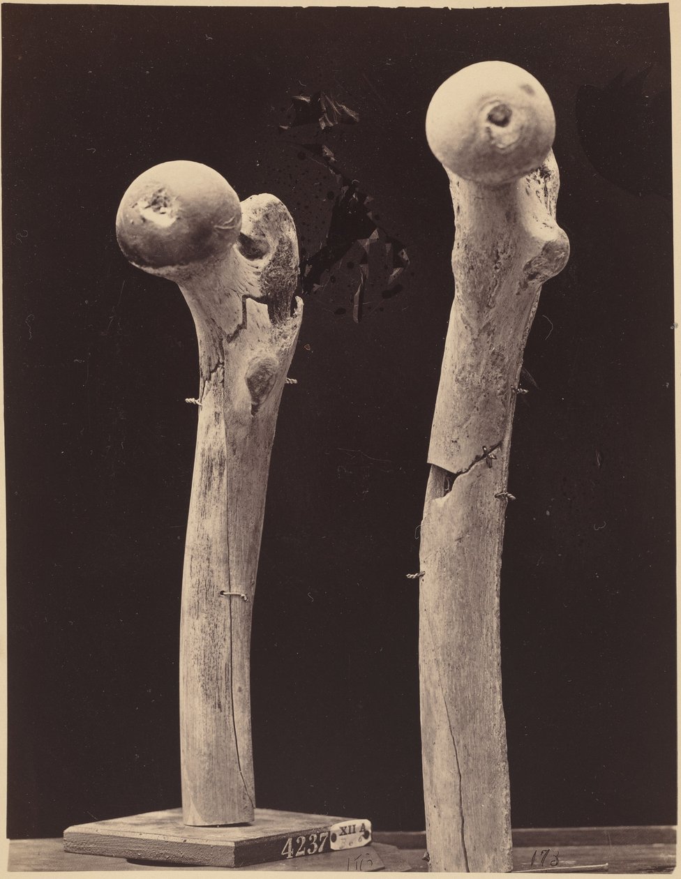 Vzorky střelných zlomenin stehenní kosti,c. 1867 (foto) od American Photographer