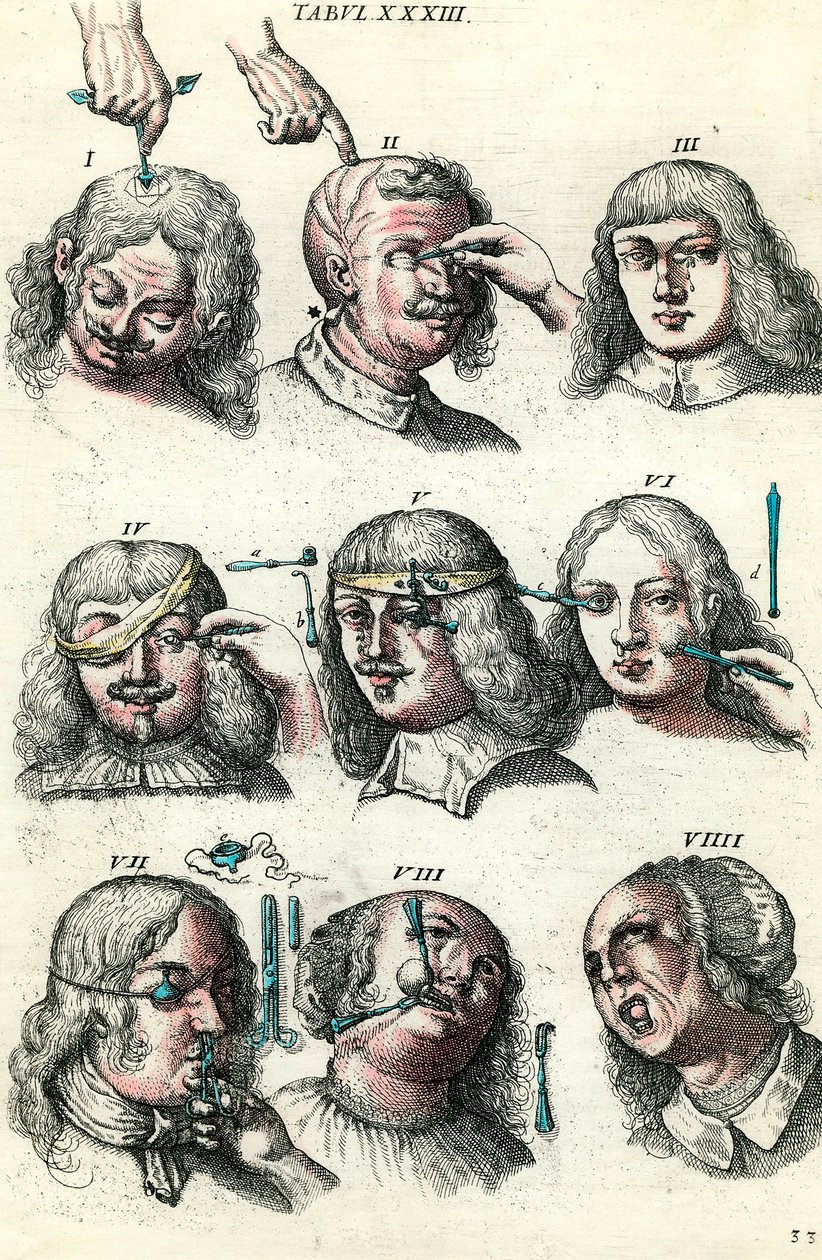 Chirurgie v 18. století: Trepanace a operace oka a obličeje. Rytina v „Institutions chirurgicale“ od Lorenze Heistera od Anonymous Anonymous