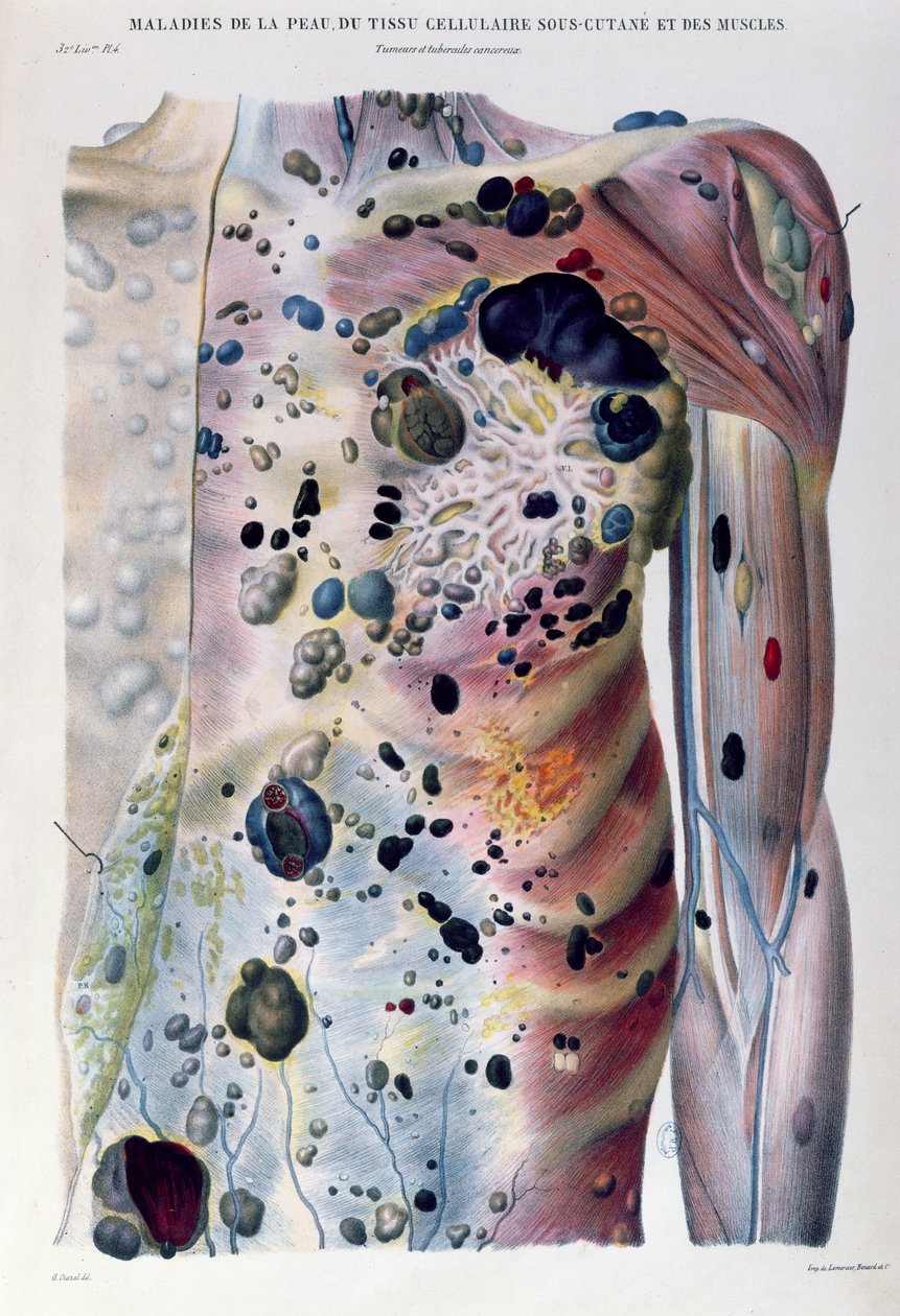 Nádory a rakovinné tuberkulózy, z „Anatomie Pathologique du Corps Humain“ od Jean Cruveilhier (1791-1874) 1828-42 od Antoine Chazal