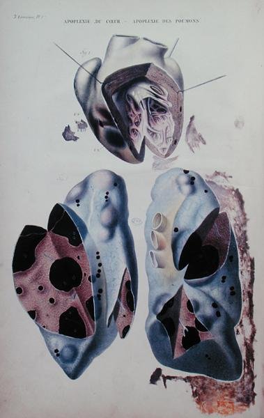 Apoplexie srdce a plic, ilustrační deska z „Anatomie pathologique du corps humain“ od Jean Cruveilhier (1791-1874), vydané v Paříži od Antoine Chazal