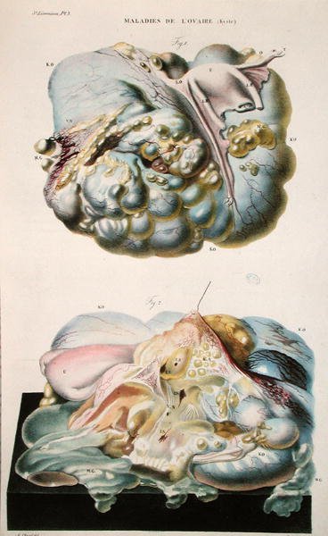 Nemoci vaječníků, z „Anatomie Pathologique du Corps Humain“ od Jean Cruveilhier (1791-1874) 1828-42 (barevná rytina) od Antoine Chazal