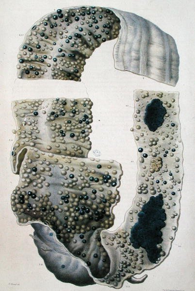 Nemoci střev, z „Anatomie Pathologique du Corps Humain“ od Jean Cruveilhier (1791-1874) 1828-42 (barevná rytina) od Antoine Chazal