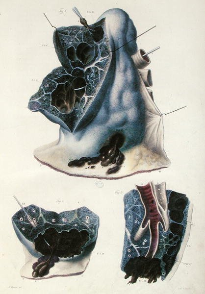 Nemoci plic, z „Anatomie Pathologique du Corps Humain“ od Jean Cruveilhier (1791-1874) 1828-42 (barevná rytina) od Antoine Chazal