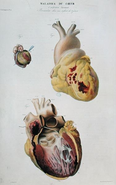 Deska zobrazující srdeční choroby. Spontánní ruptura srdce 86leté ženy (obr. 1) a perikarditida u šestidenního dítěte (obr. 2), z „Anatomie pathologique du corps humain“ od Jeana Cruveilhiera (1791-1874), vydaného v Paříži od Antoine Chazal