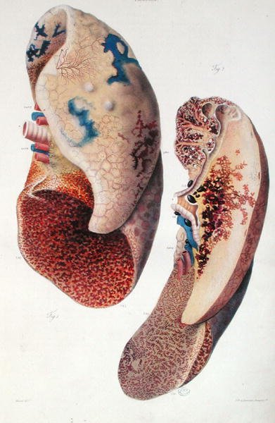 Pneumonie, z 