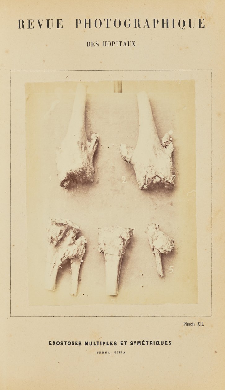 Mnohočetné symetrické exostózy, femur, tibie od Arthur de Montmeja