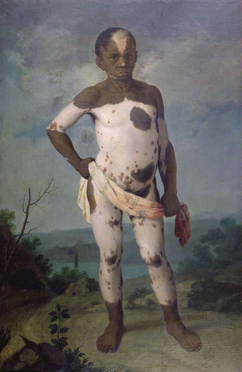 Dítě s vitiligem, 1786 od Brazilian School