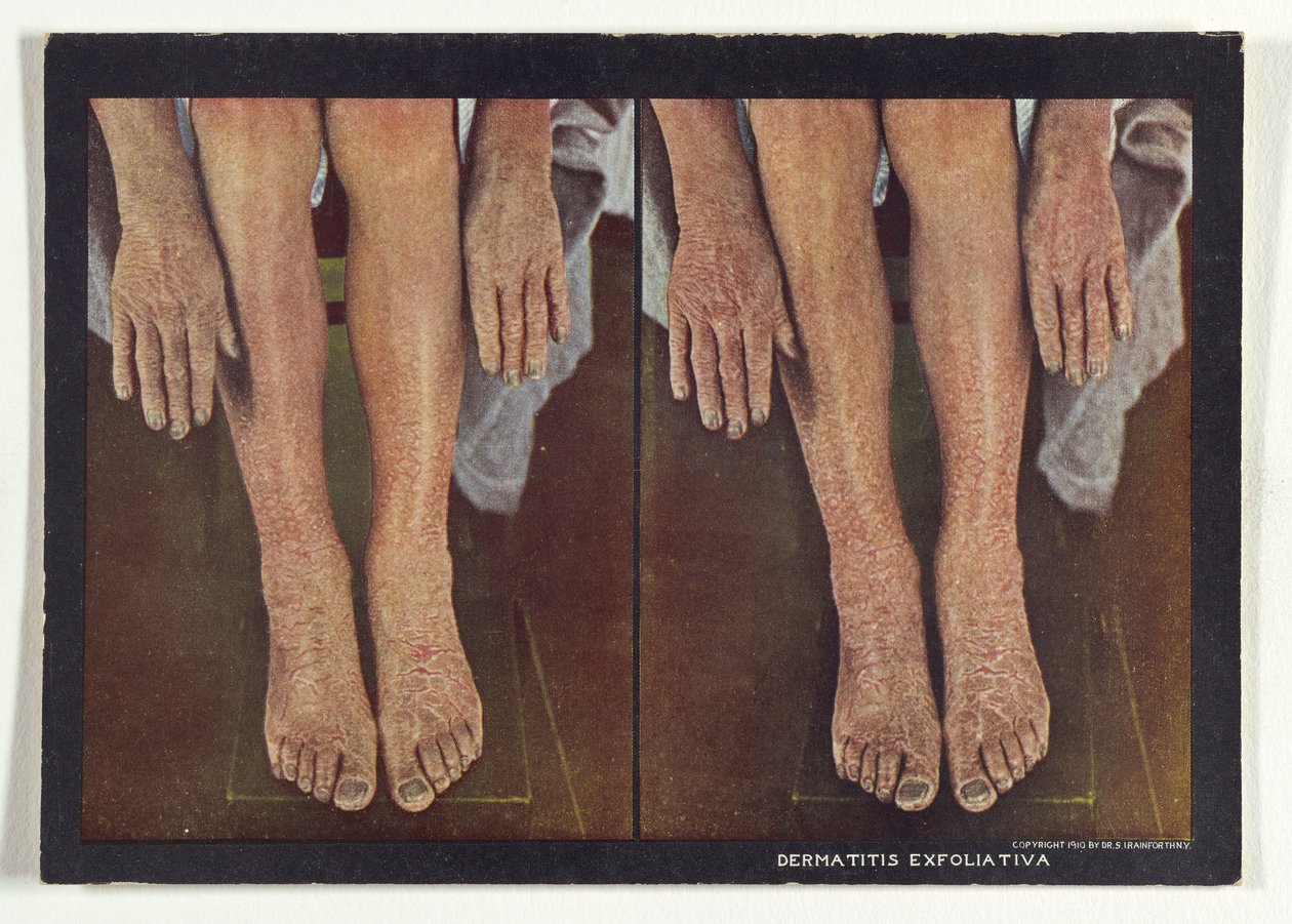 Dermatitis exfoliativa od Dr. Selden I. Rainforth