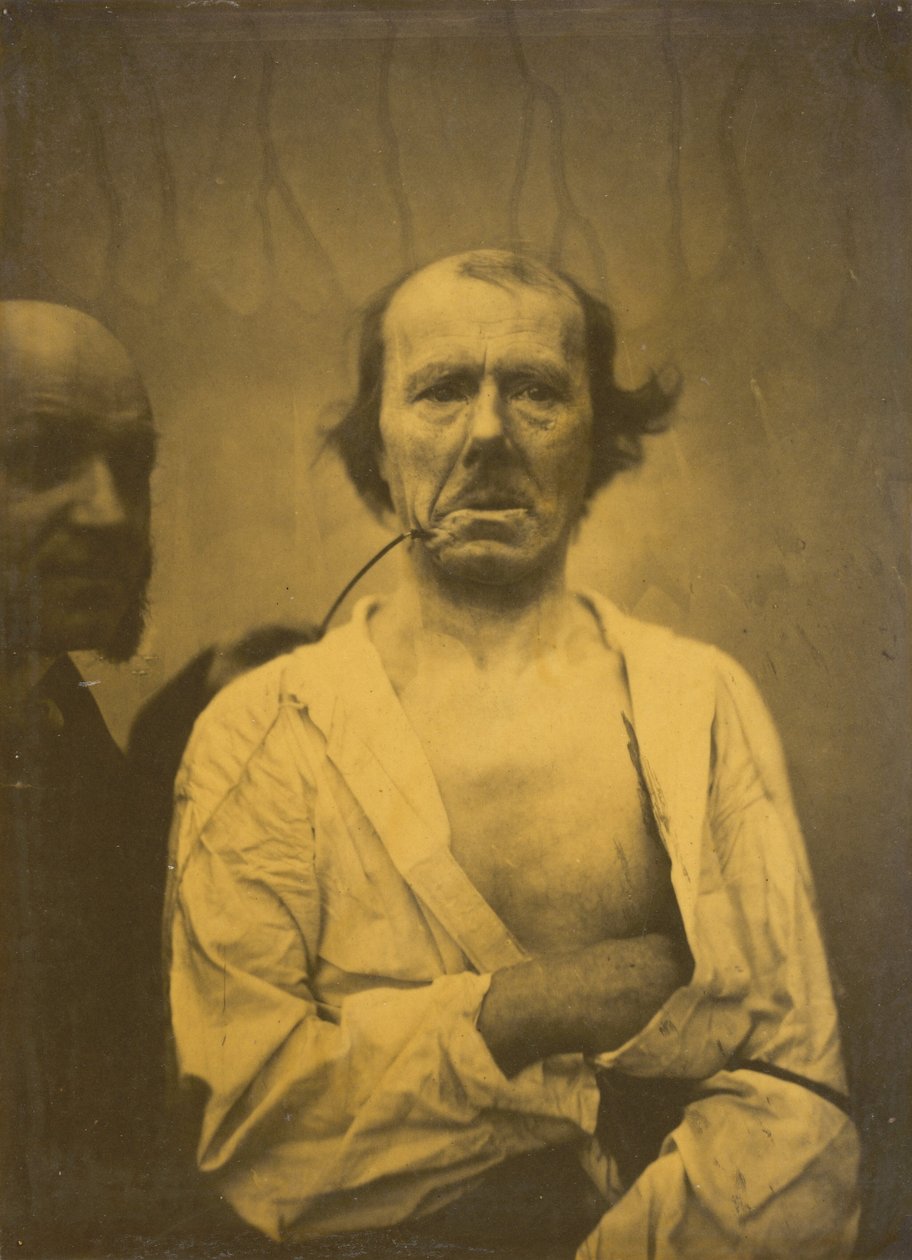 Uvolněný výraz vlevo, Znechucení vpravo, 1854-1856, vytištěno 1862. od Duchenne de Boulogne