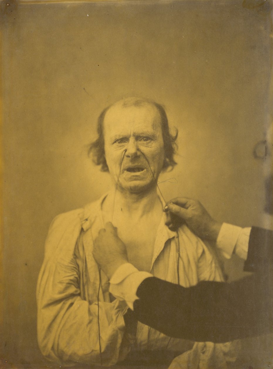 Nespokojenost, špatný humor, 1854-1856, vytištěno 1862. od Duchenne de Boulogne