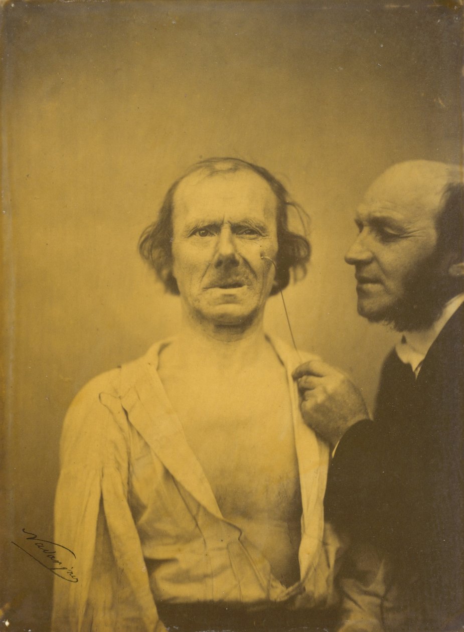 Pláč, vlevo slzy lítosti, vpravo uvolněná tvář, 1854-1856, tištěno 1862. od Duchenne de Boulogne