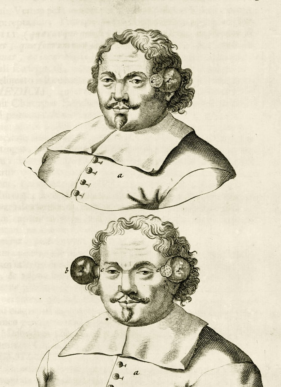 Příklad baňkování z The Practice of Medicine od Frederika Dekkerse, 1694 od Dutch School