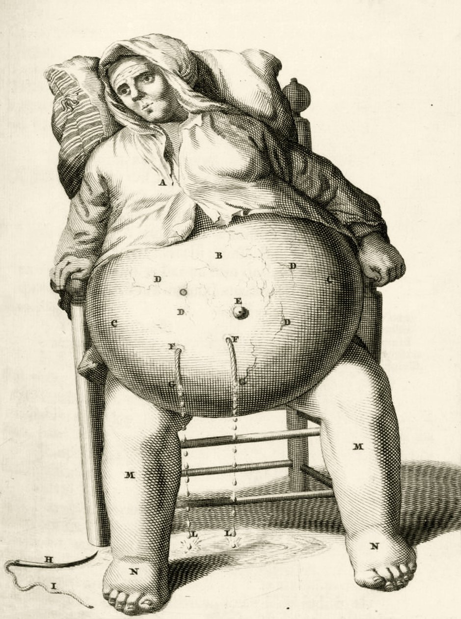 Vypouštění tekutin z abscesu Frederik Dekkers, 1694 od Dutch School