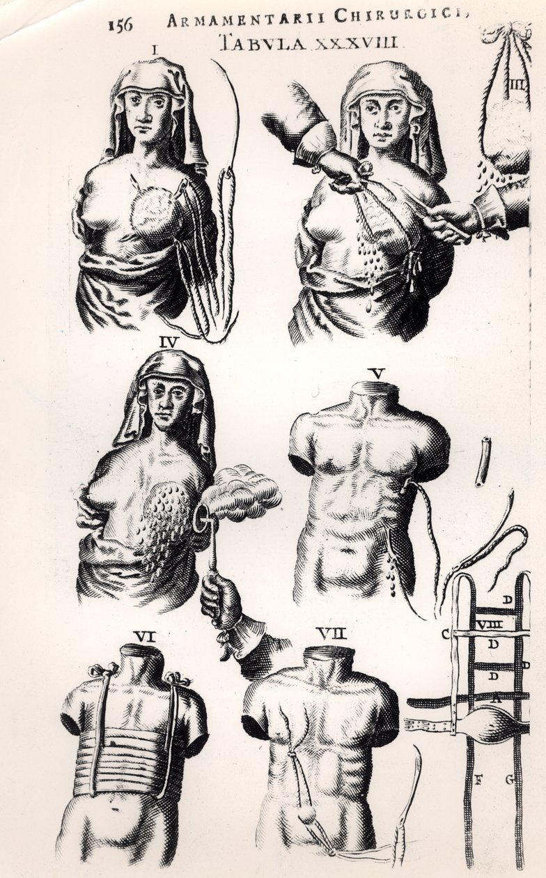 Operace rakoviny prsu, od Armamentarii Chirurgici od Johannese Schultese (1595-1645), publikované v Amsterdamu, 1672 od Dutch School
