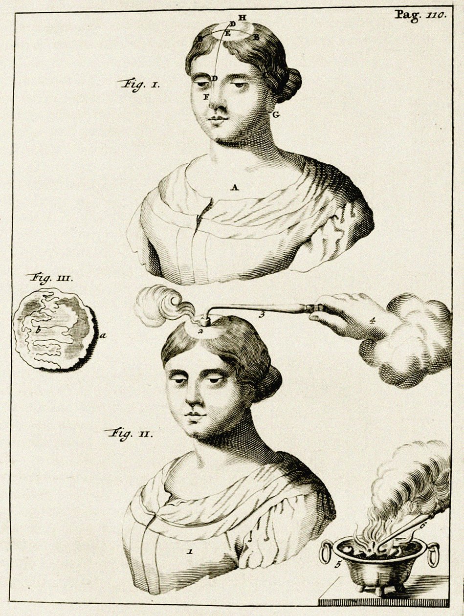 Léčba pacienta trpícího epilepsií z cvičení v lékařské praxi Frederik Dekkers, 1694 od Dutch School