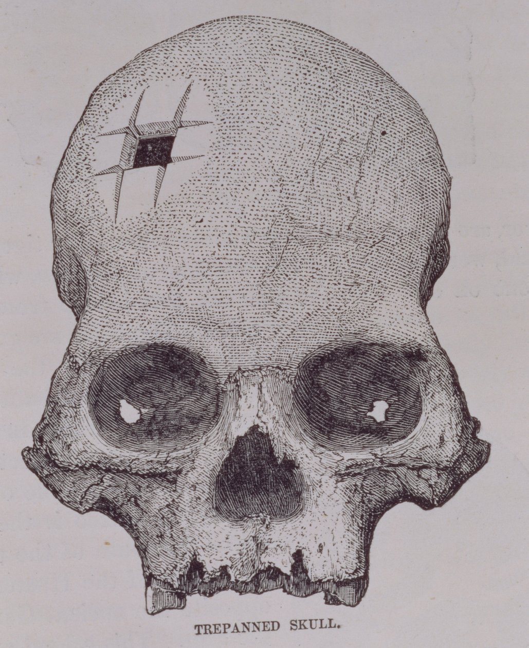 Trepanned Skull, z 