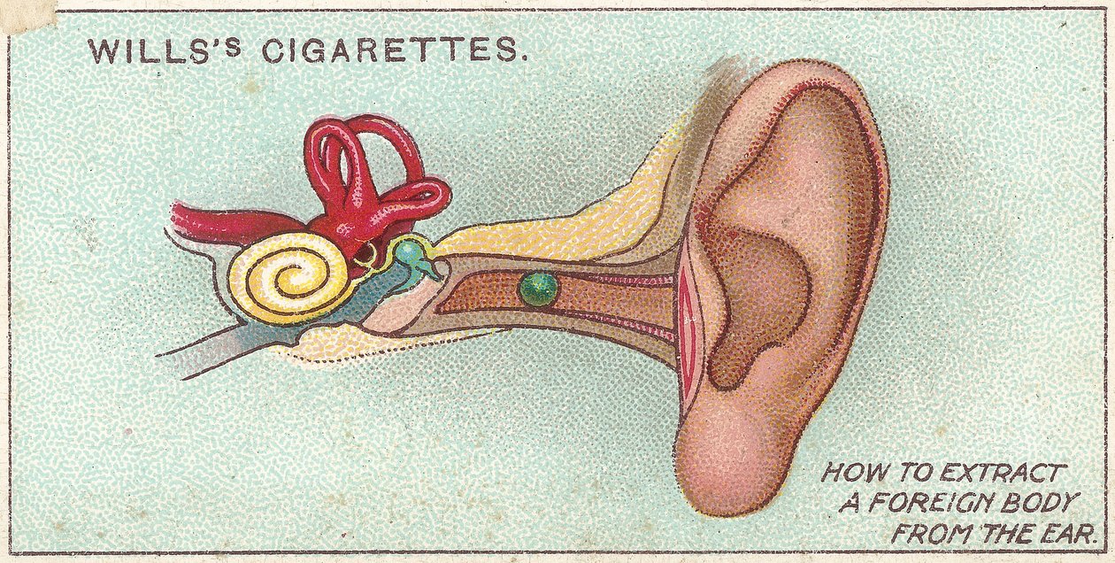 Cizí těleso v uchu, ne. 30 ze série cigaretových karet Willss First Aid, 1913 od English School