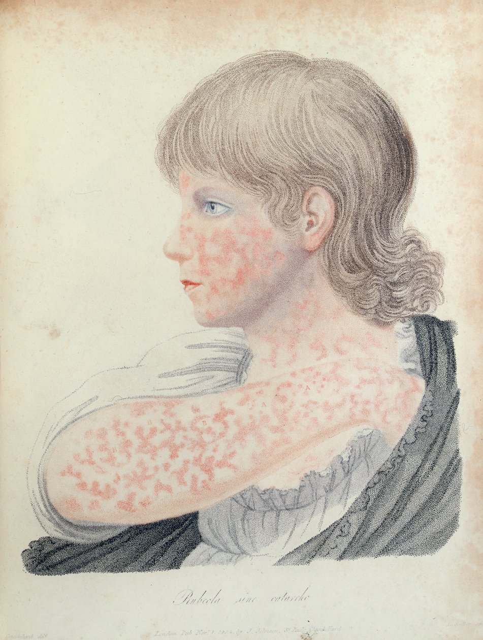 Německé spalničky, ilustrace ke knize Roberta Willana (1757-1812), 1808 (barevná rytina) od English School