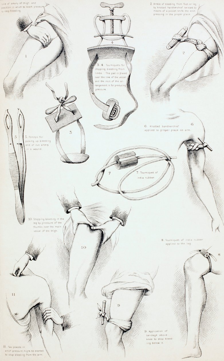 Metody zatčení krvácení, c.1890 od English School