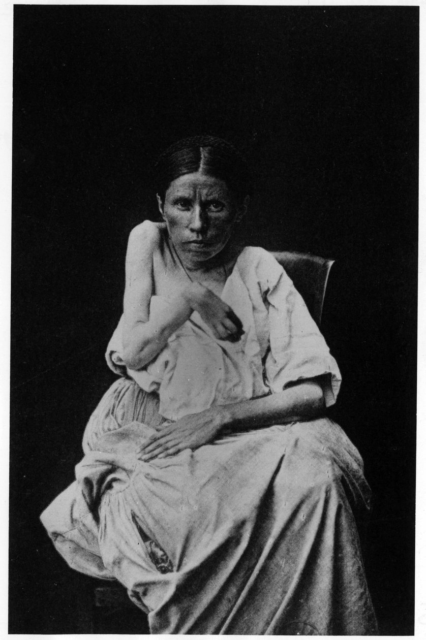 Fotografie pacienta trpícího hemiplegickou epilepsií, -in "" fotografická ikonografie Salpetrière, Bourneville a P. Regnard, Paříž od French Photographer