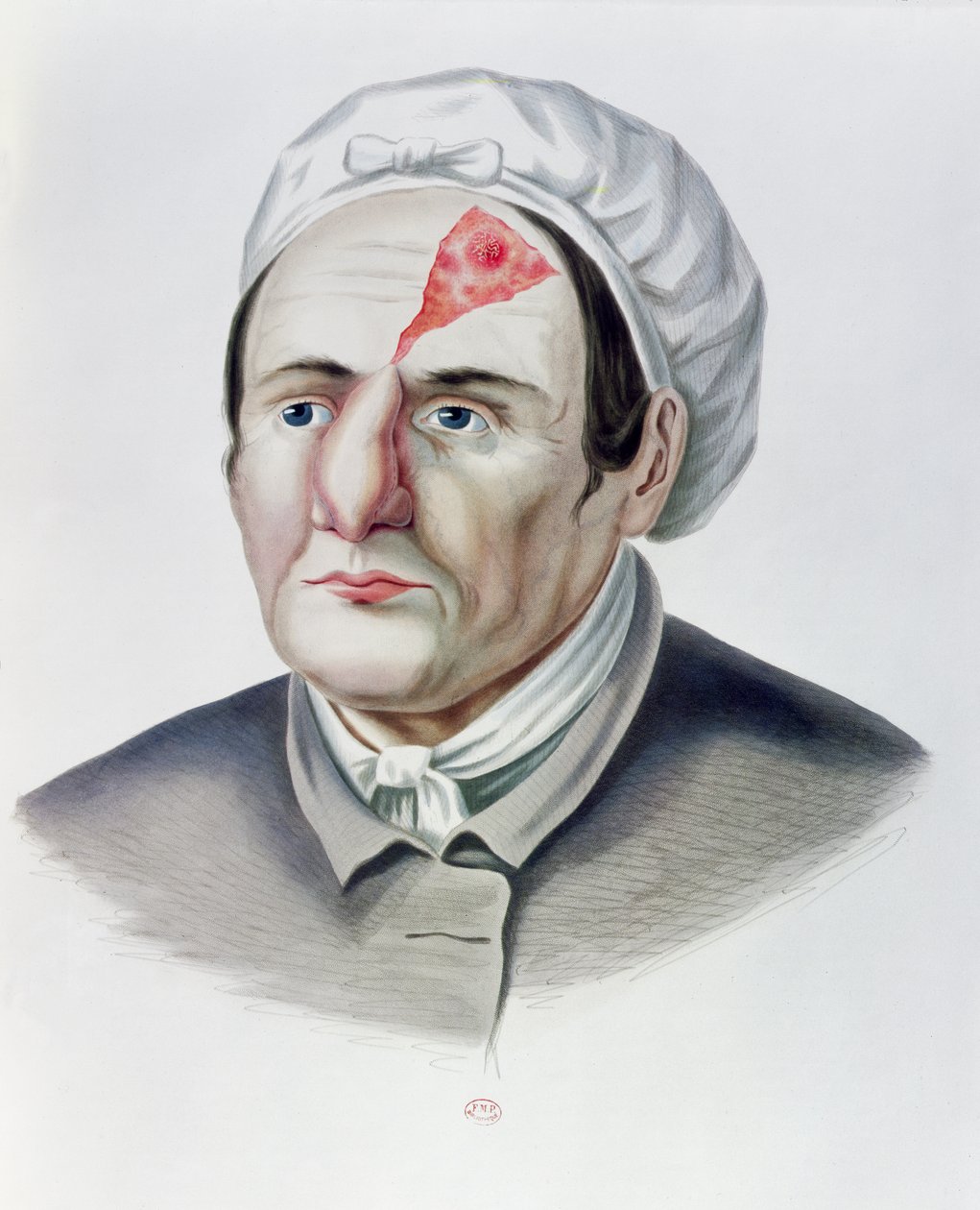 Po operaci kožního štěpu z Selecta Praxis Medico-Chirurgica od Alexandra Auverta, Paříž, 1856 od French School