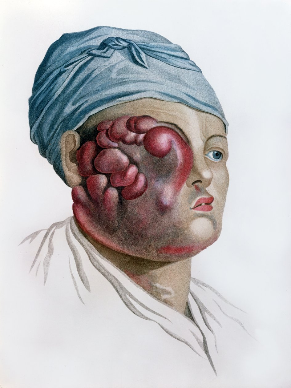 Cancerous scrofula, z Description des Maladies de la Peau od barona Jean Louis Alibert (1768-1837) Paříž, 1806 od French School