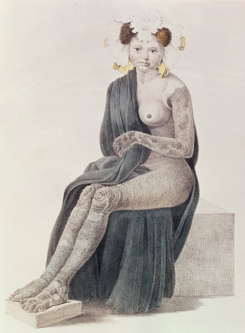 Vrozená ichtyóza, z knihy G.M. Olbers, 1830 od French School