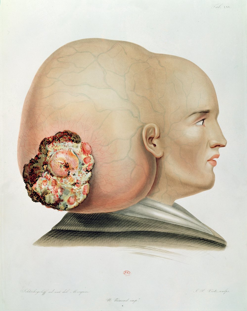Houba dura mater, z Selecta Praxis Medico-Chirurgica od Alexandra Auverta, Paříž, 1856 od French School