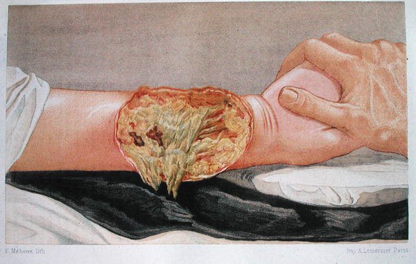 Hospital Gangrene, z 