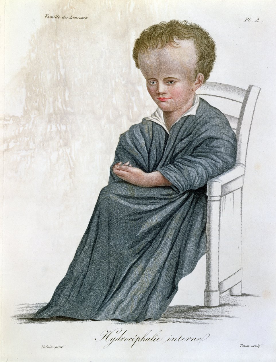 Vnitřní hydrocefalus, z Nosologie Naturelle od barona Jean Louis Alibert (1768-1837), rytý Trescou, 1817 od French School