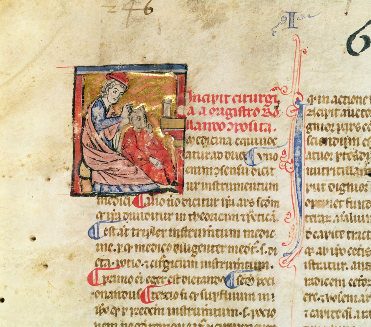 paní Lat. 7134 fol. 1 Trepanation, od Chirugie de Maitre Rolandi od French School