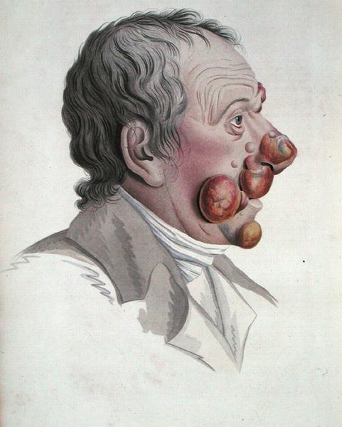 Mycosis Fongoide, z knihy barona Jean Louis Alibert (1768-1837) 1838 (barevná rytina) od French School