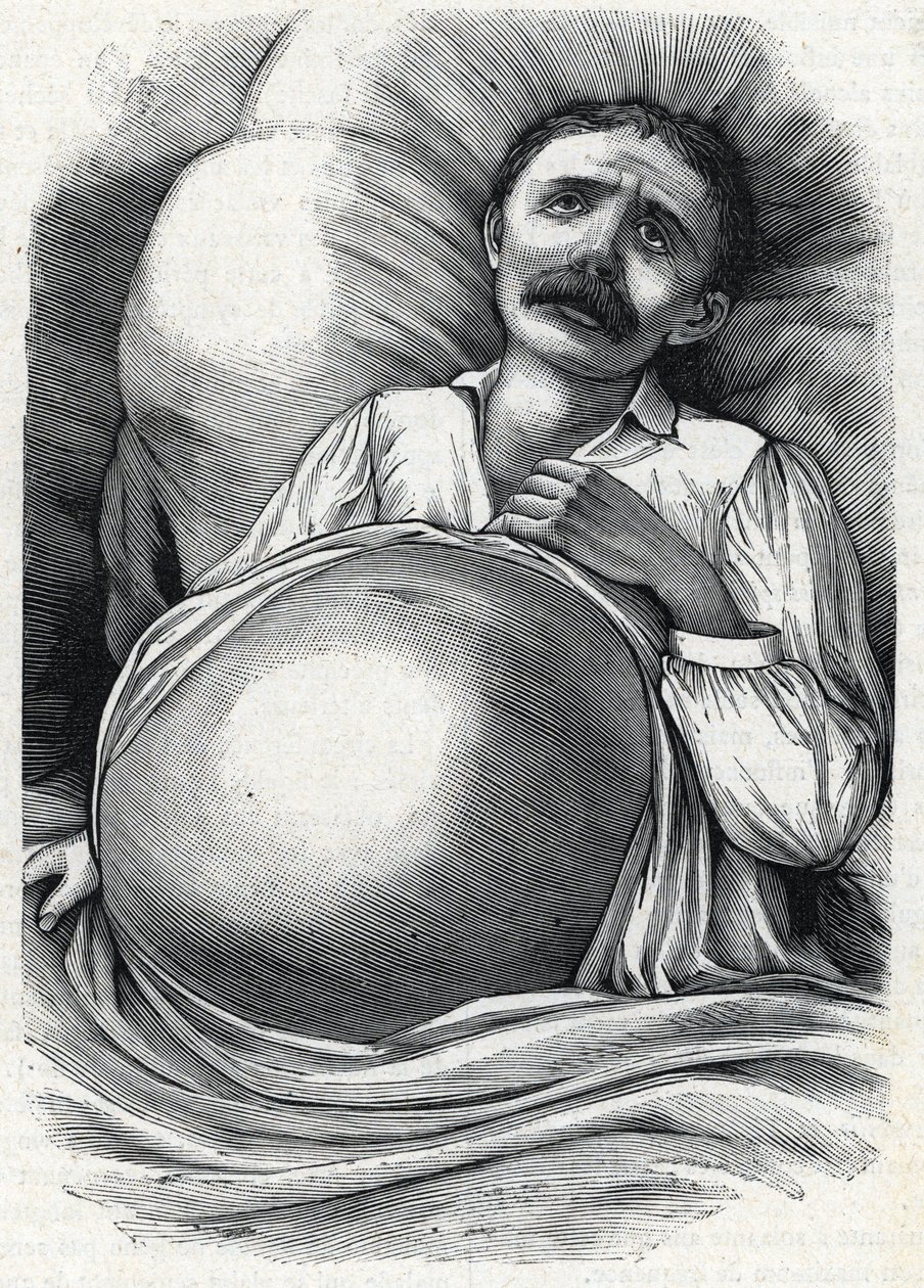 Pacient s pokročilou cirhózou jater (rytina) 1888 od French School