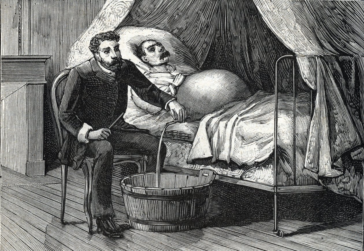 Pacient s pokročilou jaterní cirhózou, lékař provádějící punkci (rytinu) 1888 od French School