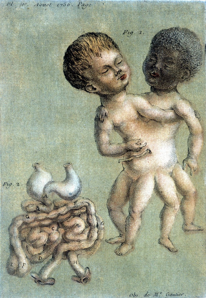 Talíř medicíny představující siamské bratry: bílý a černý. ilustrace Toussainta (1756) v „Periodická pozorování fyziky, přírodní historie a umění“. od French School