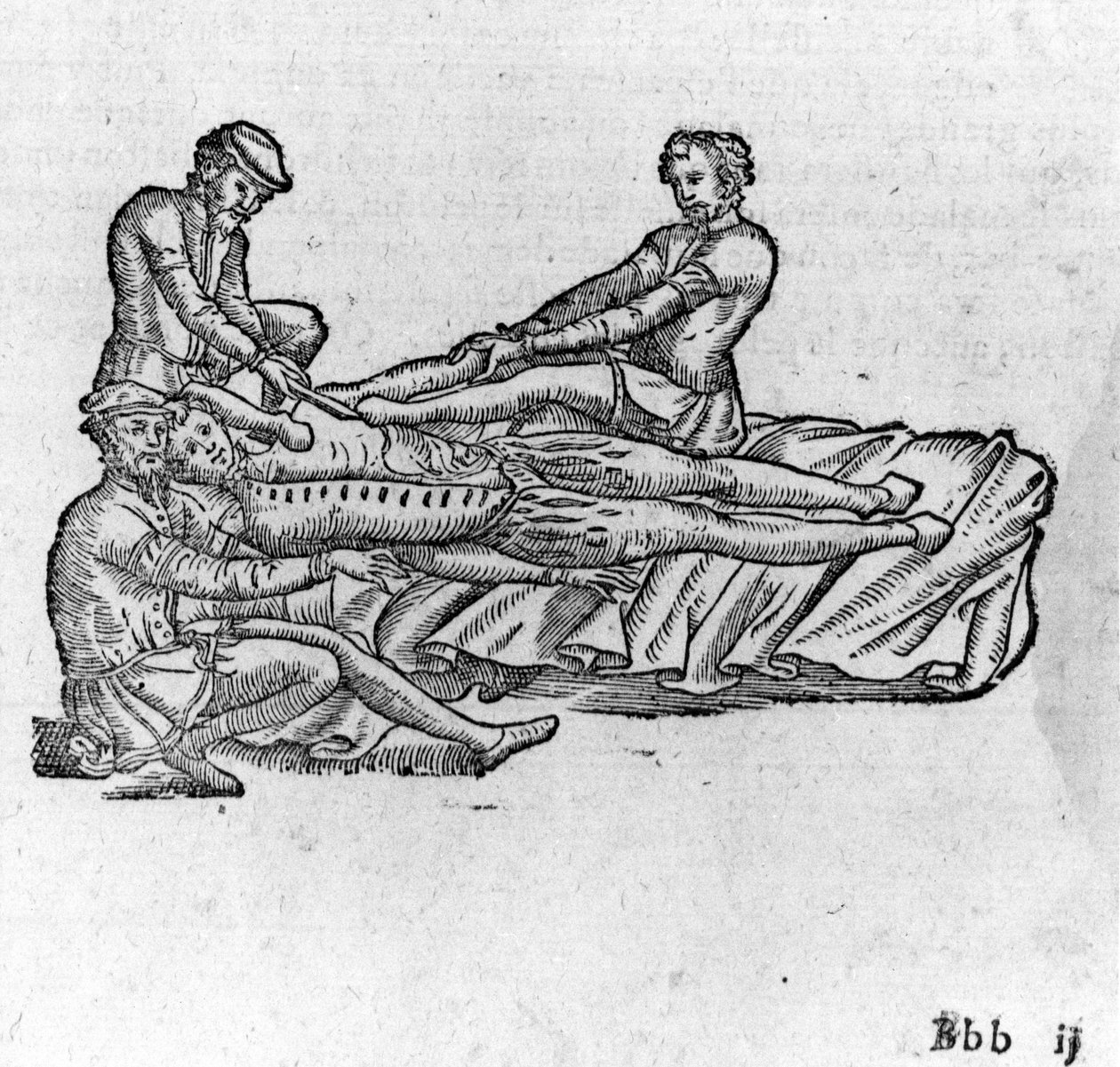 Redukce luxace, v „Lékařském pojednání Ambroise Paré“, kolem roku 1560. od French School