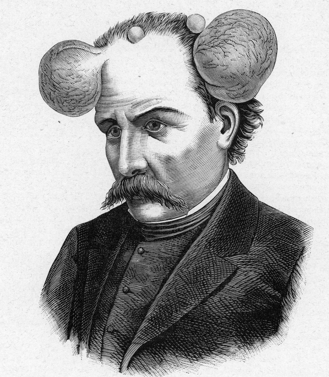Znázornění osoby s lupou, cysty na hlavě (rytina) od French School