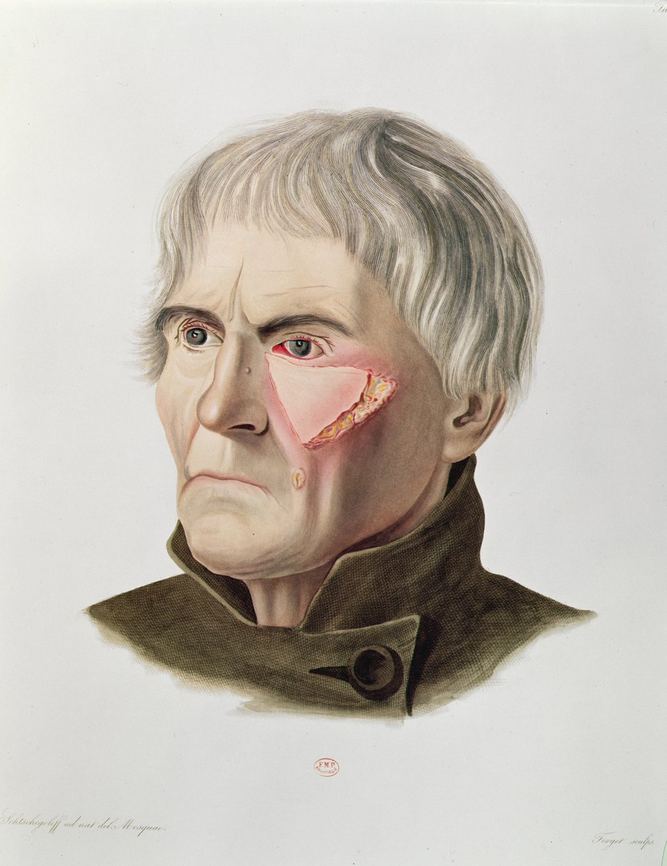 Operace kožního štěpu, z Selecta Praxis Medico-Chirurgica od Alexandra Auverta, Paříž, 1856 od French School