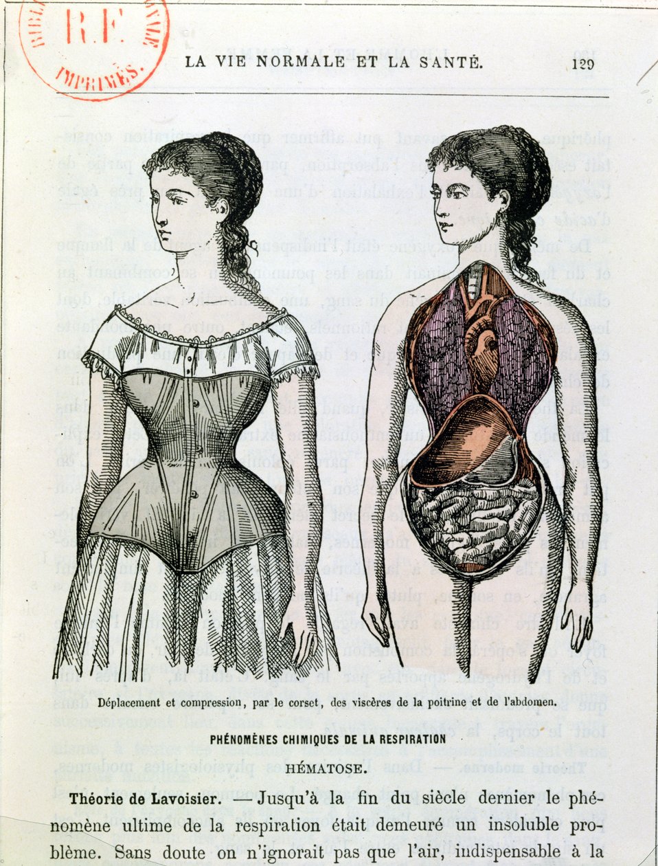 Škodlivé účinky korzetu, ilustrace z La Vie Normale et la Sante od Dr. Julese Rengadea (nar. 1841) kolem roku 1880 od French School