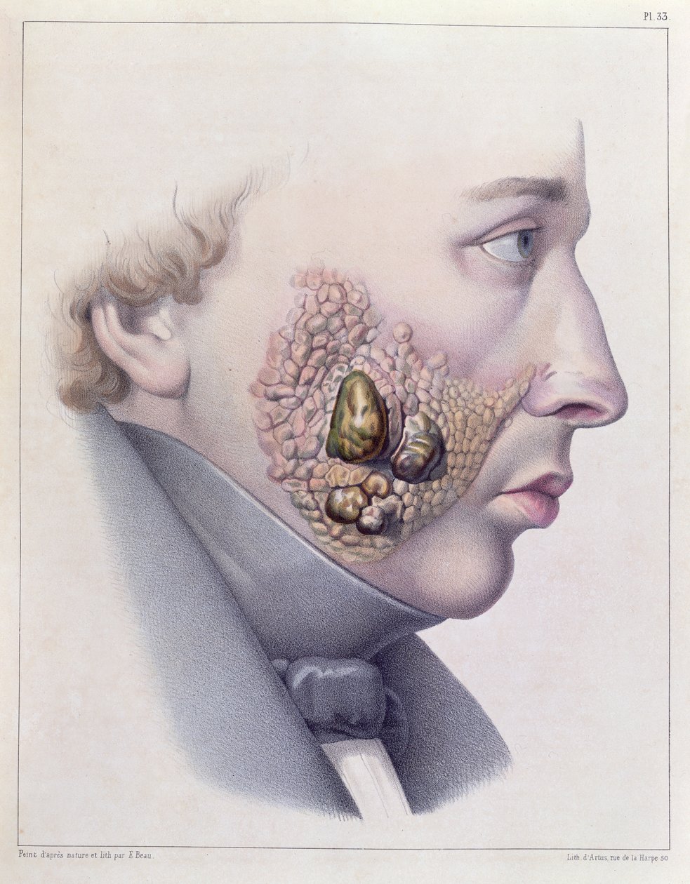 Obličejové příznaky pohlavní choroby, z Traite Complet des Maladies Veneriennes od Philippa Ricorda (1800-89) 1851 od French School