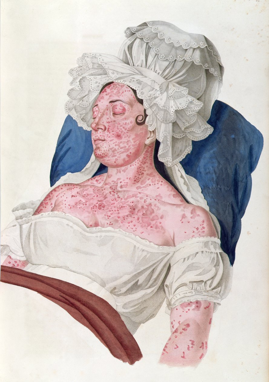 Žena s šarlatovou horečkou, z knihy barona Jeana Louise Aliberta (1768-1837), vyryté Choupardem, 1833 od French School
