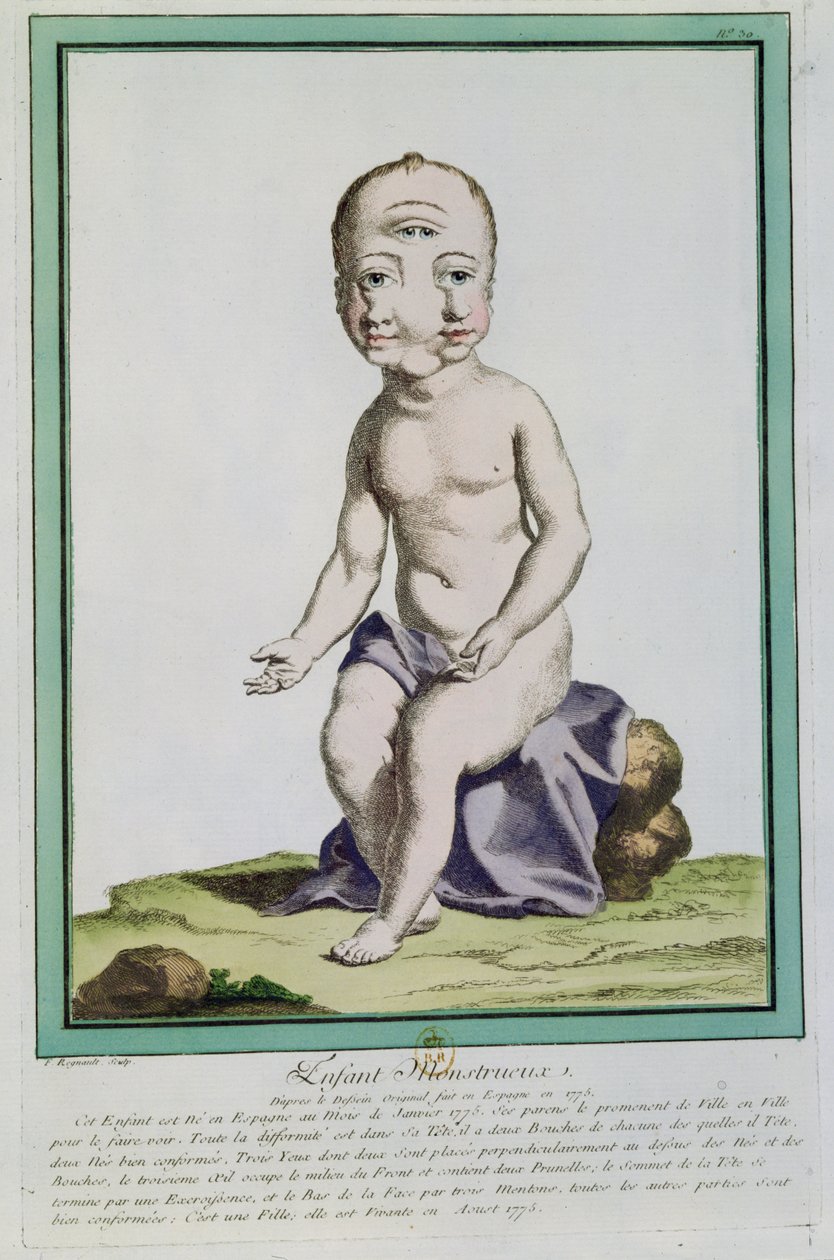 Dítě s deformovanou hlavou, z „Les Ecarts de la Nature“, Paříž, 1775 od Genevieve Regnault de Nangis
