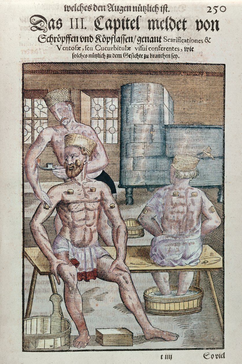 Baňkování, z Ophthalmodouleia od Georga Bartische (1535-1636) vydané v Drážďanech v roce 1583 (barevný dřevotisk) od German School