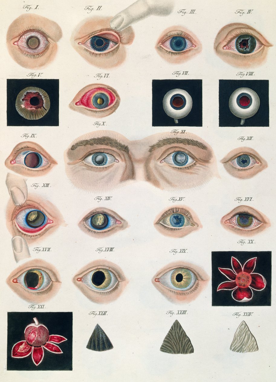 Popis vrozených očních anomálií, z Klinických popisů nemocí a zrakových vad lidského oka, Friedrich August von Ammon (1799-1861) 1838 od German School