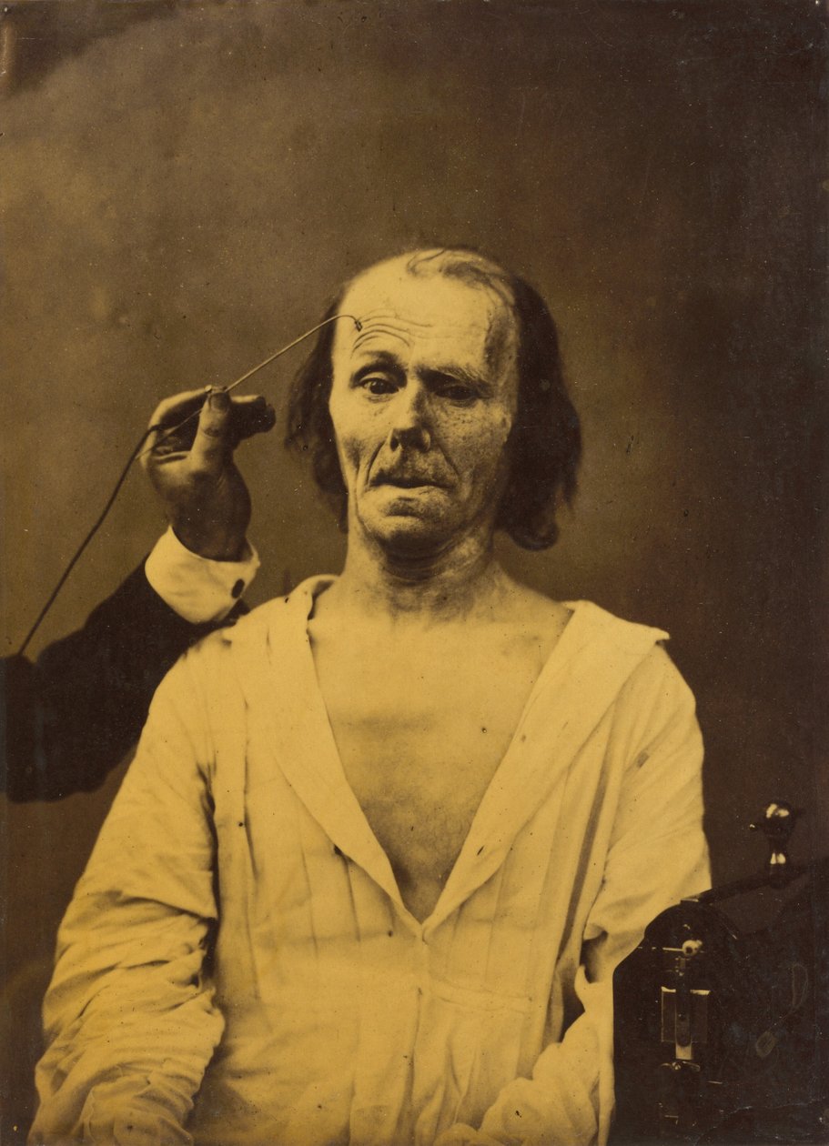 Uvolněná tvář (vlevo); Hluboká pozornost (vpravo),1854-1856, vytištěno 1862 (foto) od Guillaume Benjamin Armand Duchenne de Boulogne