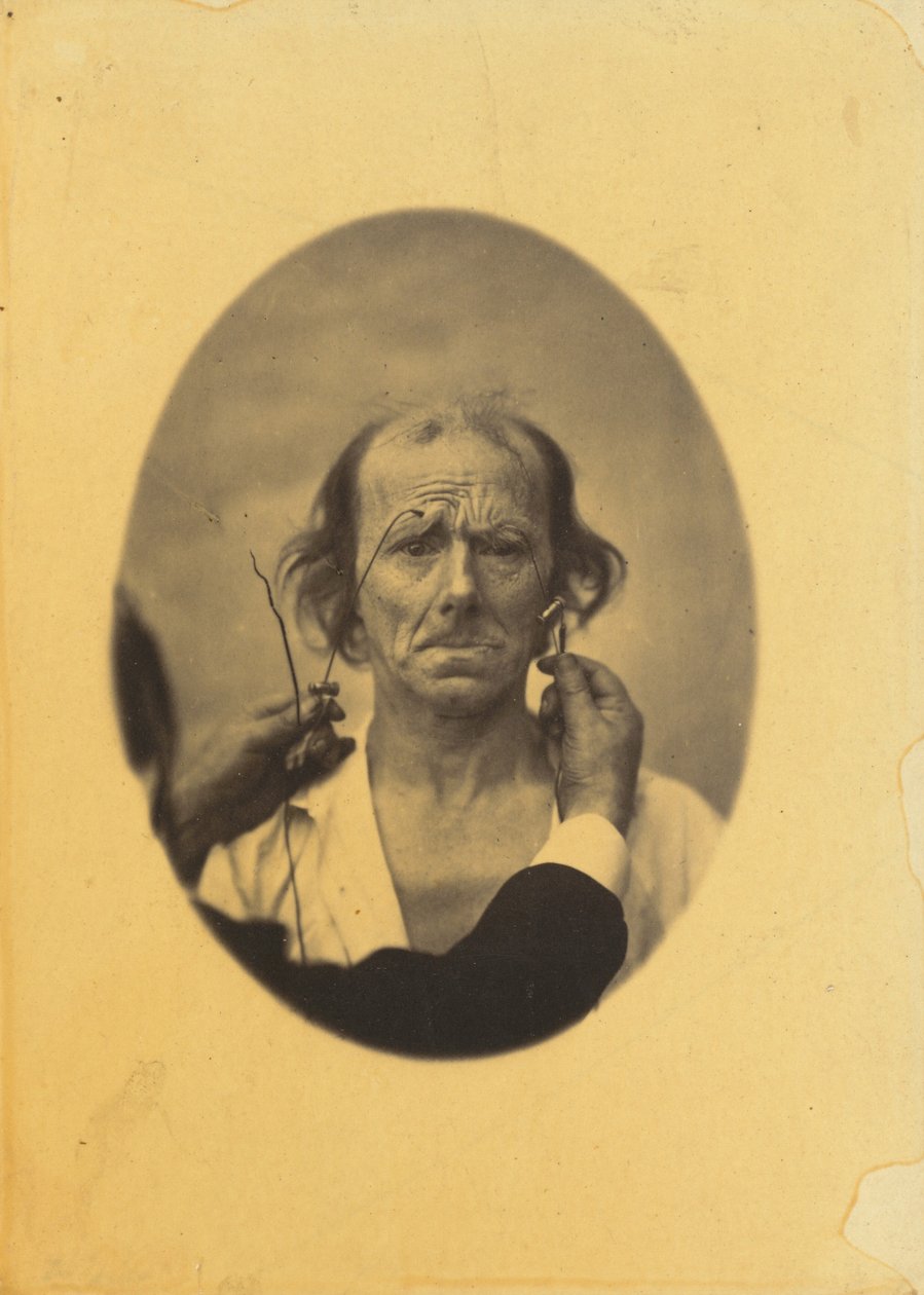 Nespokojenost, chmurné myšlenky (vlevo); Reflexe (vpravo),1854-1856, vytištěno 1862 (foto) od Guillaume Benjamin Armand Duchenne de Boulogne
