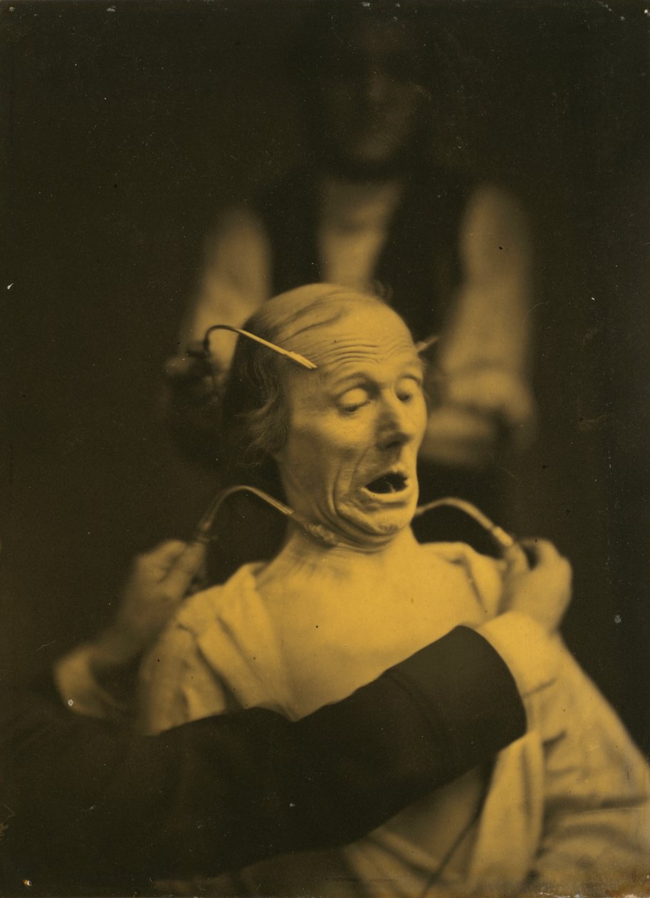 Výraz hrůzy,1854-1856, vytištěno 1862 (foto) od Guillaume Benjamin Armand Duchenne de Boulogne