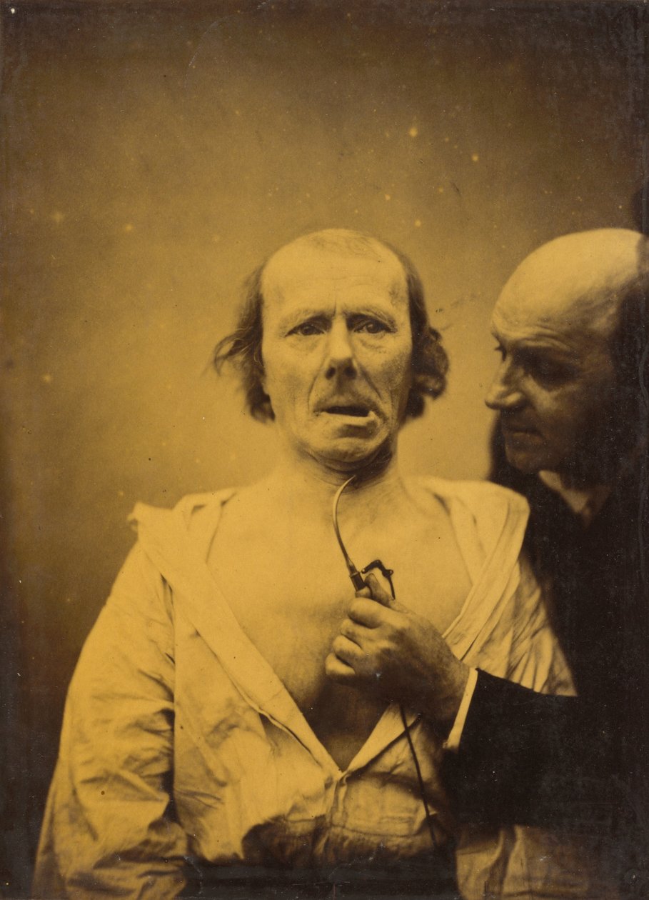 Tato kontrakce m. platysma sama o sobě postrádá výraz,1854-1856, vytištěno 1862 (foto) od Guillaume Benjamin Armand Duchenne de Boulogne