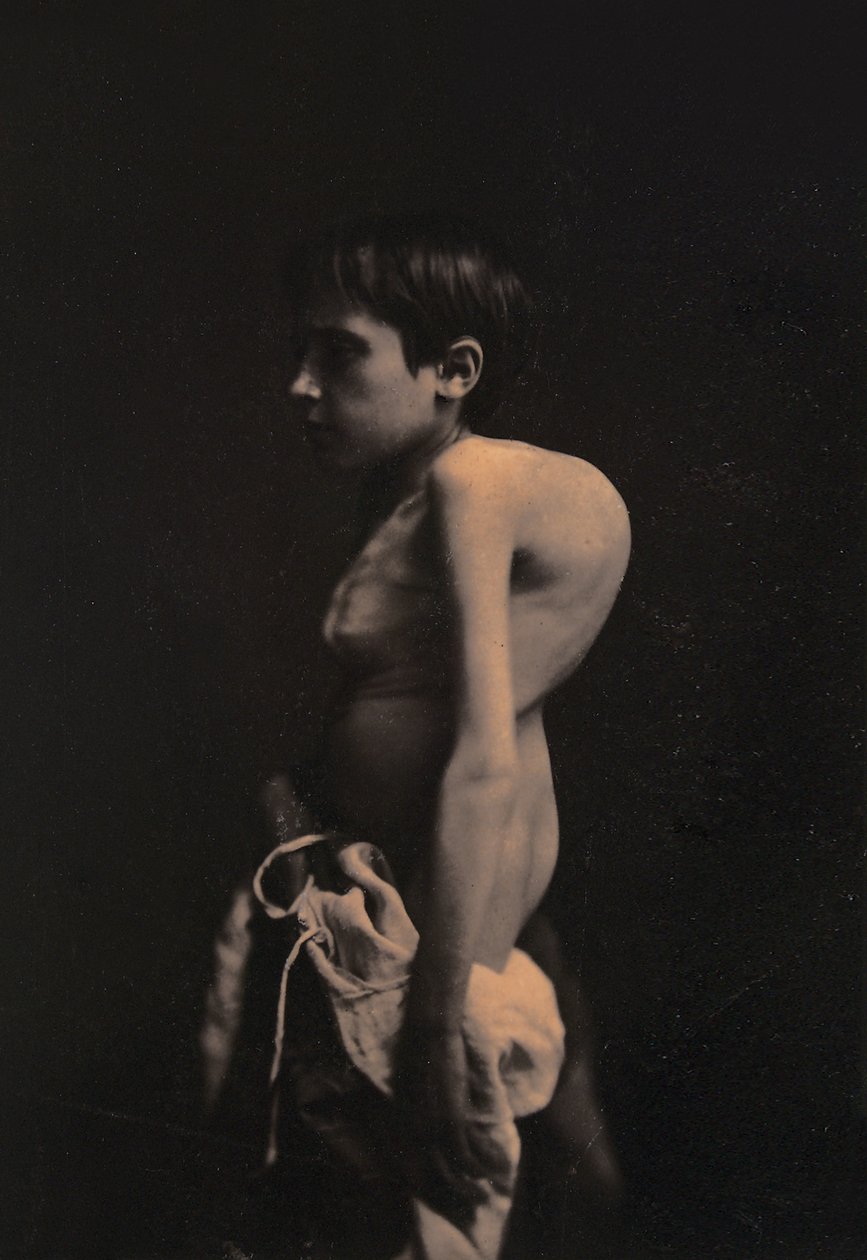 Portrét hrbatého chlapce, kolem 1855-57 od Guillaume Benjamin Armand Duchenne de Boulogne