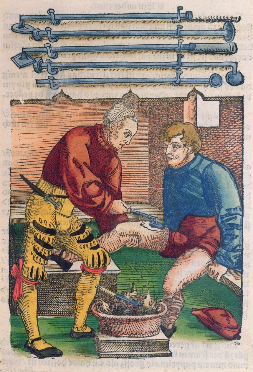 Kauterizace, ilustrace z „Feldtbuch der Wundartzney“ od Hanse von Gersdorffa, kolem 1540 (barevný dřevořez) od Hans or Johannes Ulrich Wechtlin